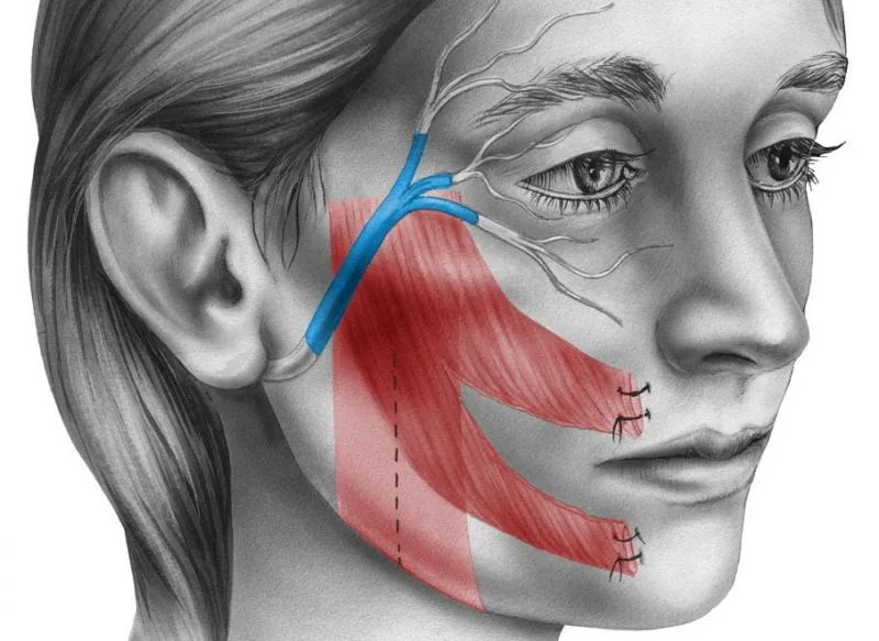 Parálisis facial